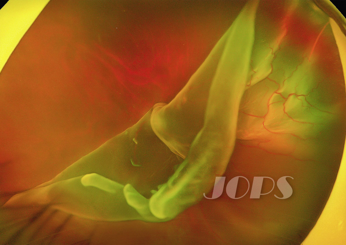 第1部門「巨大裂孔網膜剥離」